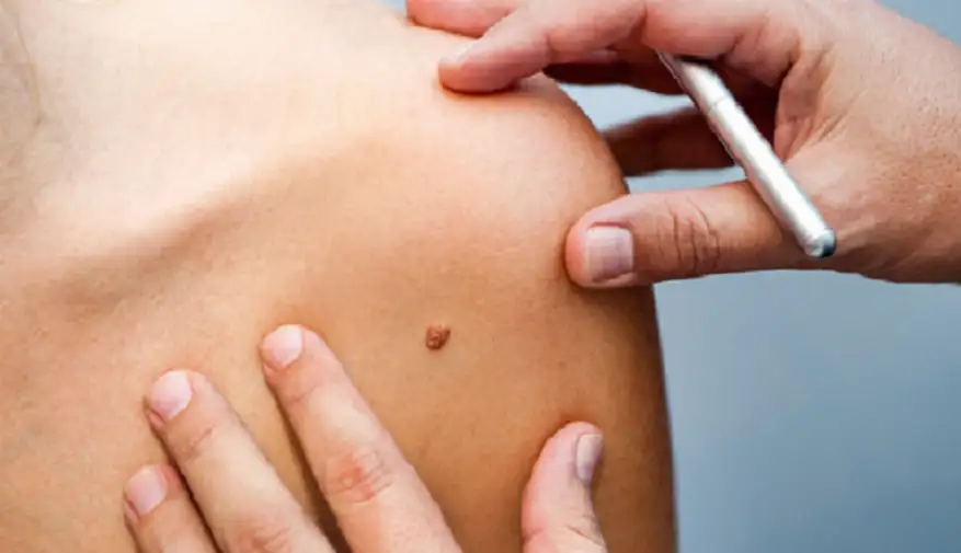 علامات لتشخيص الشامة السرطانية