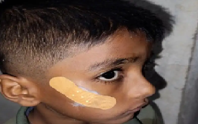 توقيف ممرضة هندية ألصقت جروح طفل