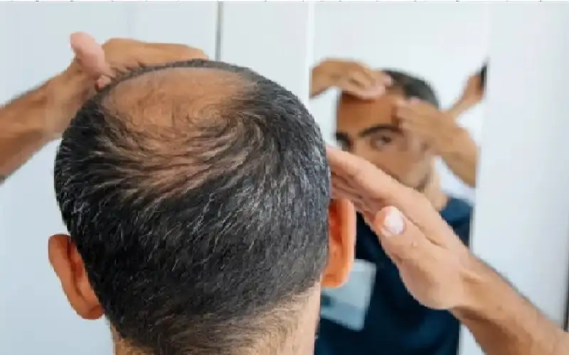 علاج جديد لتساقط الشعر يثير ضجة