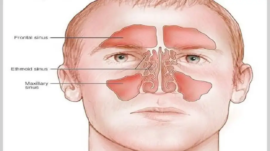 ما أعراض صداع الجيوب الأنفية؟