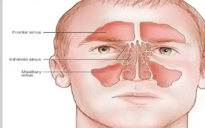 ما أعراض صداع الجيوب الأنفية؟