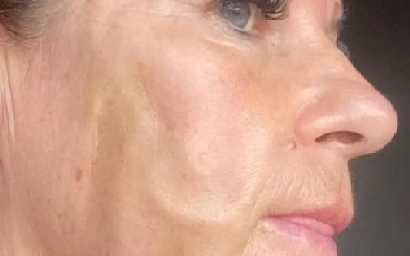 كأن دودا تحت جلد وجهها.. تشوه