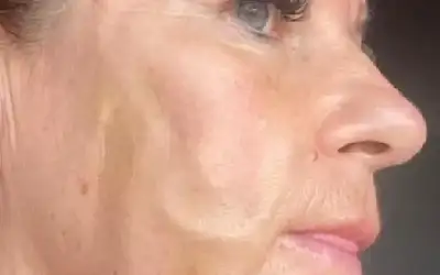 كأن دودا تحت جلد وجهها.. تشوه