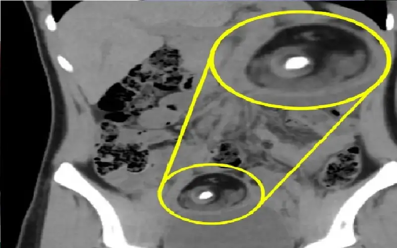 مراهقة تصاب بورم نادر.. وهذا ما