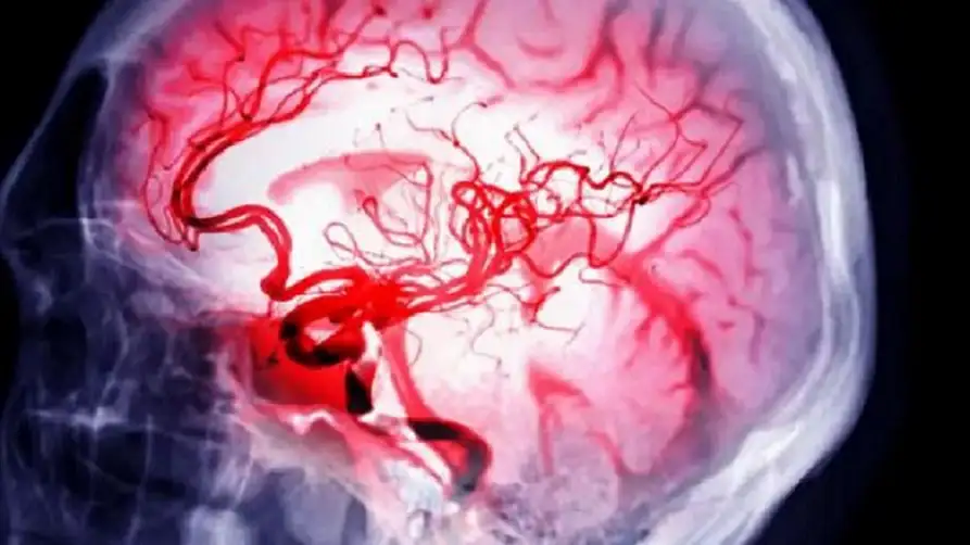 انفجار غامض بالمخ .. ماذا يحدث