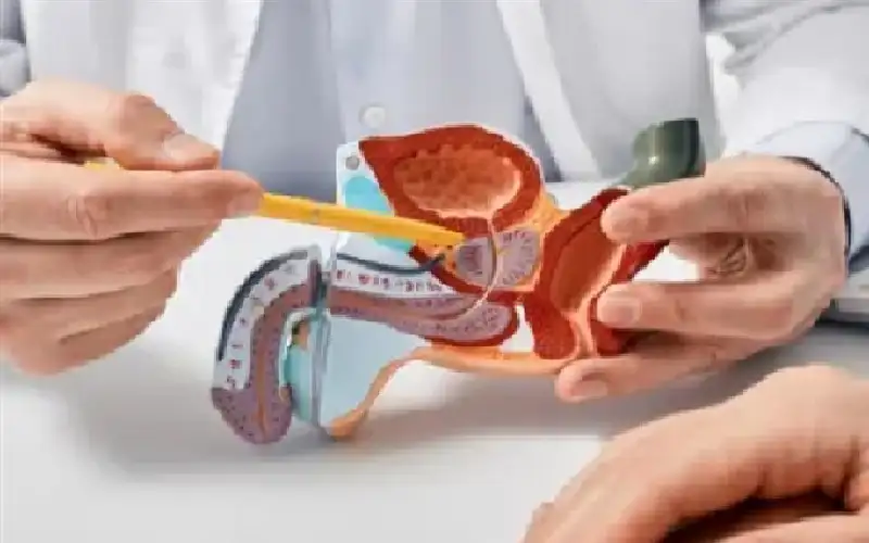 تقنية مبتكرة لتقليص أورام البروستاتا دون