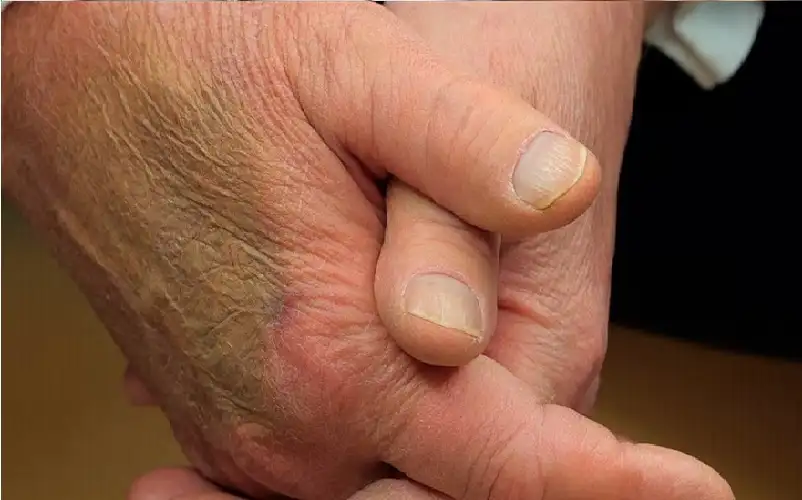 كدمة كبيرة على يد ترامب.. صورة