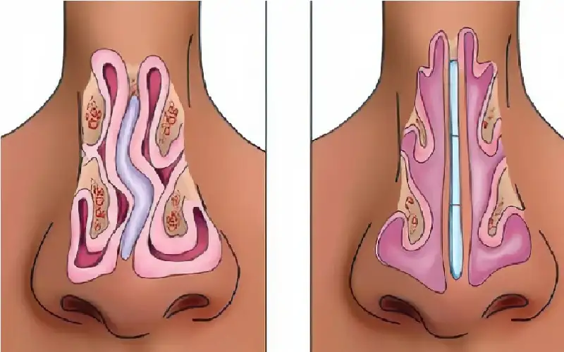 دراسة: فطريات في الأنف تفاقم الحساسية