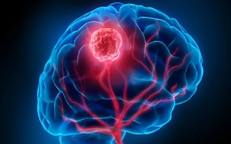 دون سابق إنذار.. صداع مفاجئ يفتك