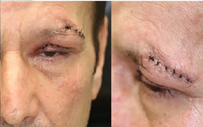 بكتيريا قاتلة تهدد عيون الألمان.. ما