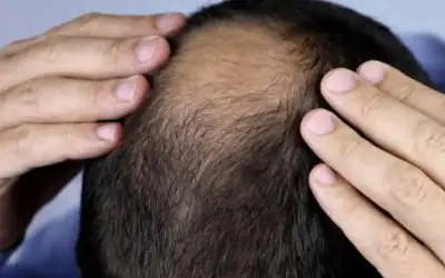 اكتشاف علمي مفاجئ في علاج الصلع