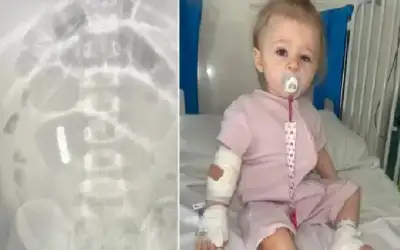 طفلة تفقد جزءا من أمعائها بسبب