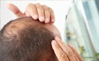 بروتين يمكنه علاج تساقط الشعر
