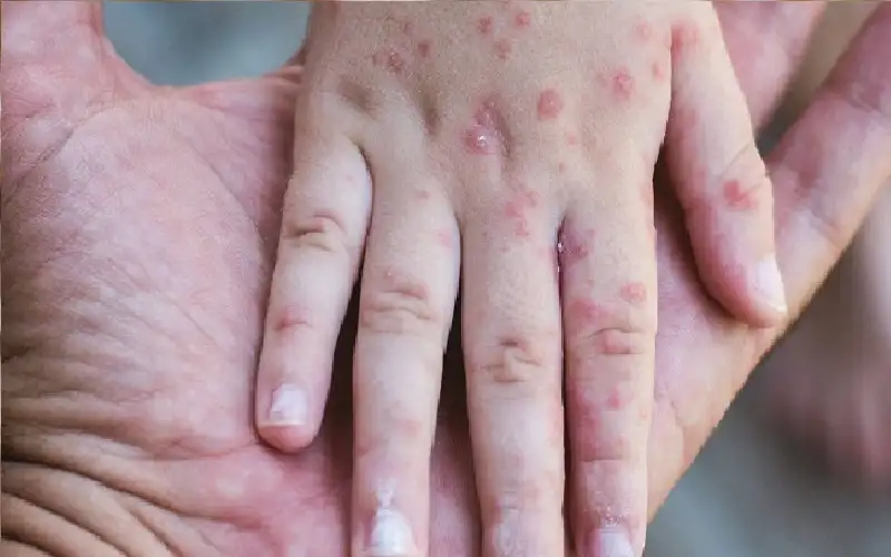 تكساس الأمريكية تسجل ثاني وفاة مرتبطة