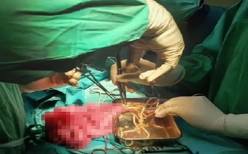صورة صادمة لطفل يتقيأ ديدانًا عملاقة بعد تناول ماء ملوث!