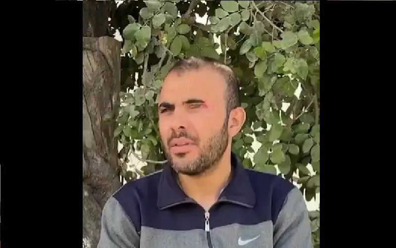 أحرقوا أجسادهم بمياه النار، والسجائر، والمواد