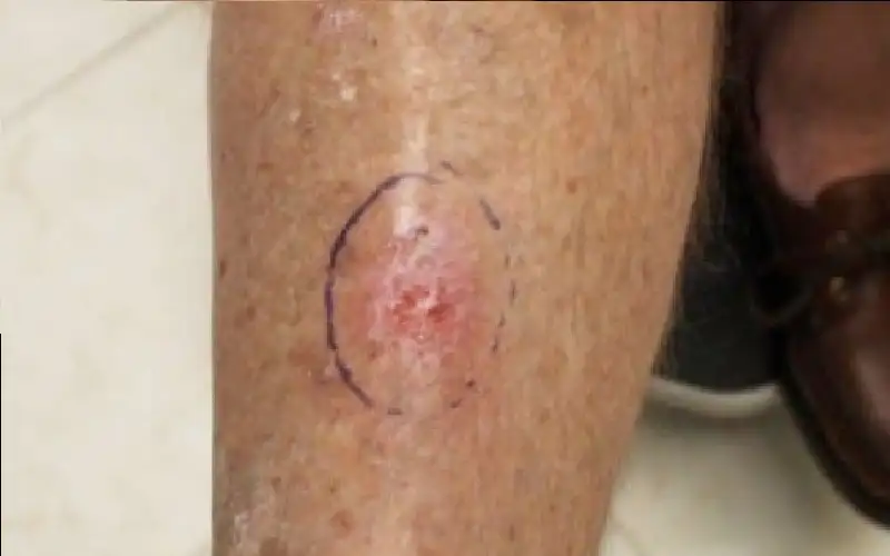 فيروس شائع يدعم علاج سرطان الجلد