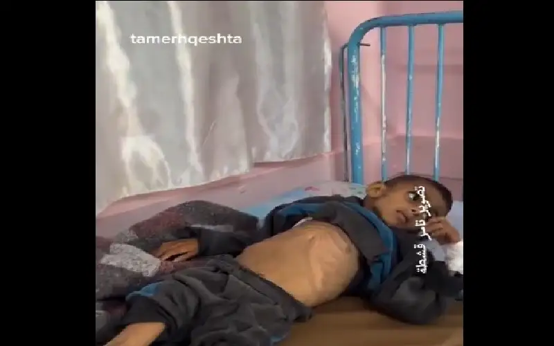 معاناة الطفل أسامة الرقب 5 سنوات