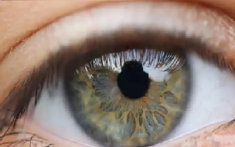 علامات في العين تنبه لإصابتك بفرط