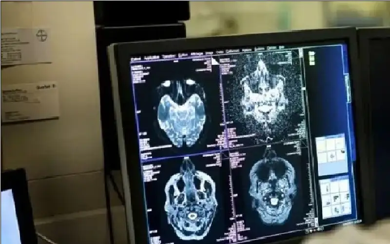 لغز المرض الغامض بالدماغ في كندا..