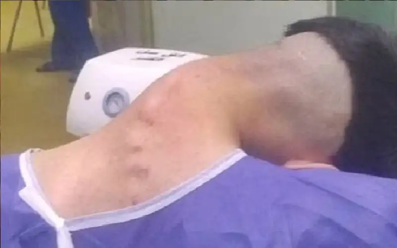 صور صادمة للإدمان.. شاب يصاب بانحناء