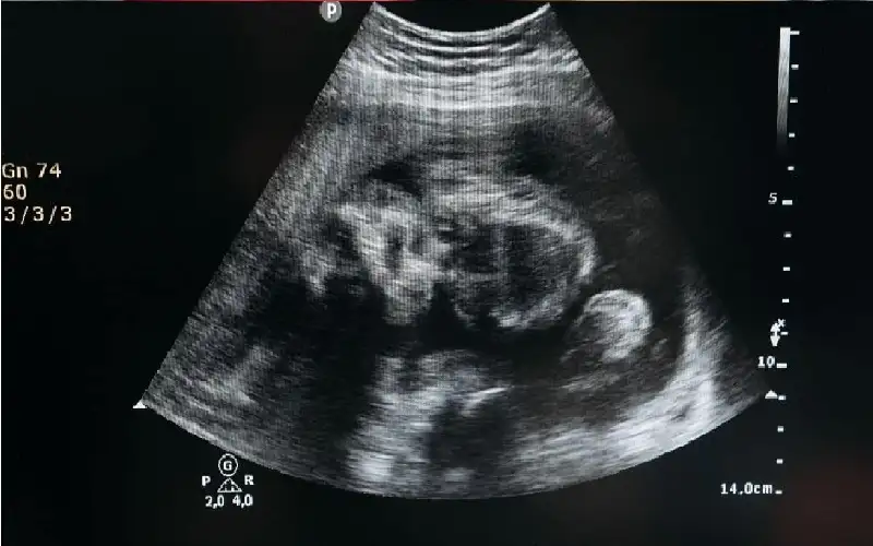 الاستلقاء على الظهر يهددك بوفاة الجنين..