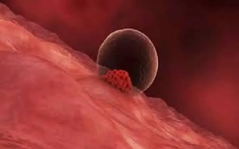 ما هو نزيف الانغراس الذي يعد