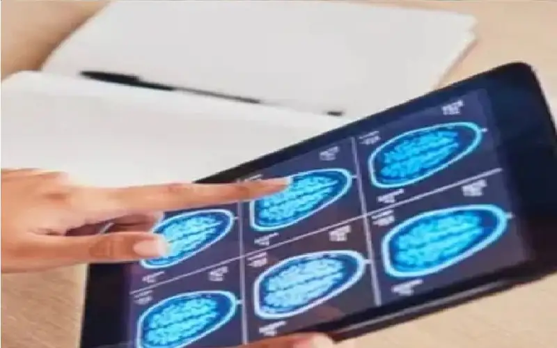 اختبار حديث يسرع تشخيص أورام الدماغ