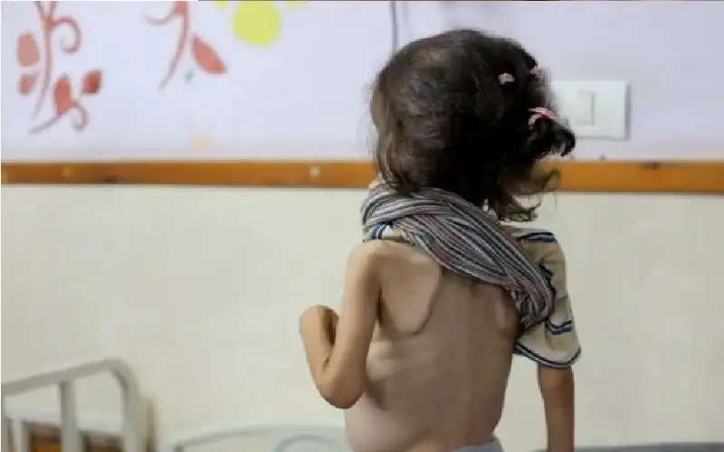 غزة: 300 وفاة بسبب نقص الغذاء