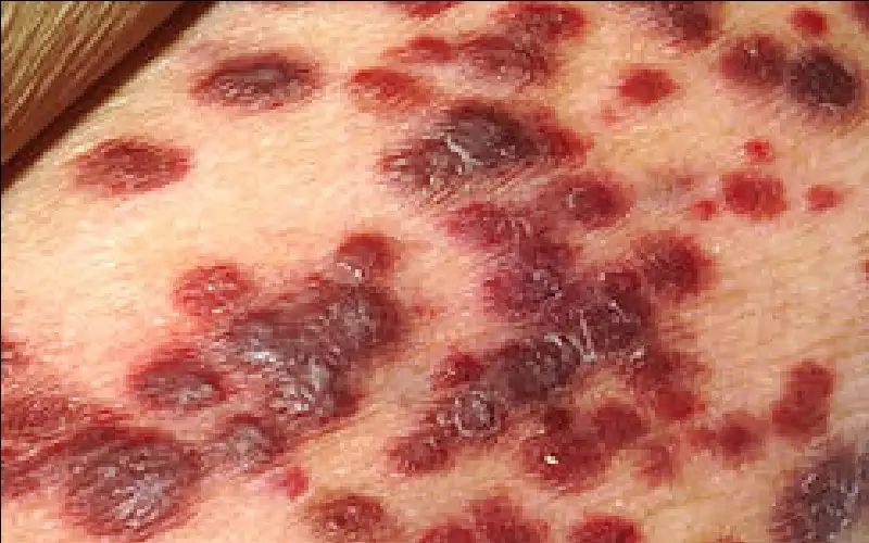 فضيحة صحية في العراق.. 3 إصابات