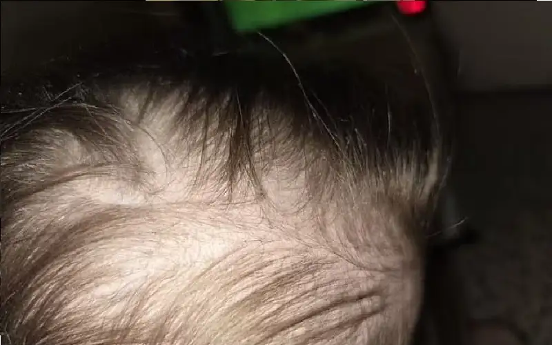 صلع وألم وعجز عن المشي.. مأساة