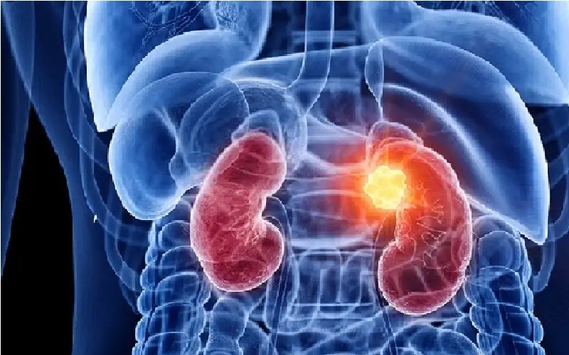 العوامل الرئيسية لتطور سرطان الكلى
