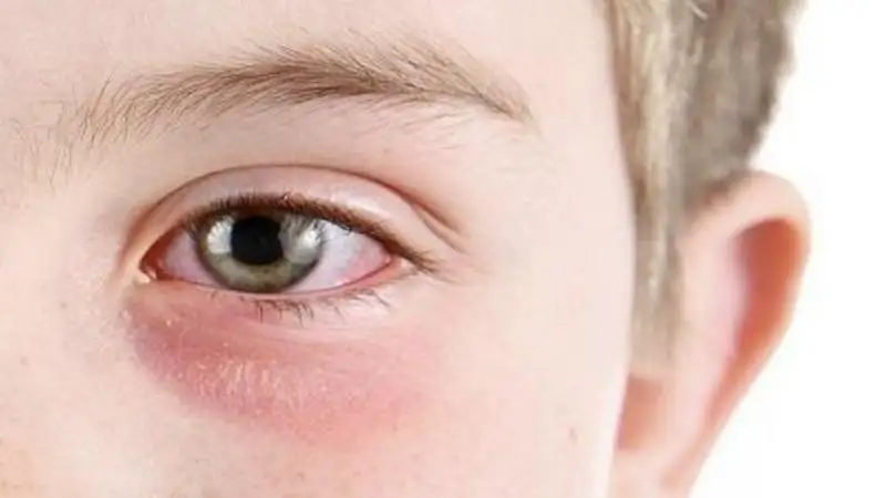 تحذير طبي مهم لمستخدمي الرموش الاصطناعية