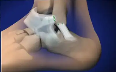 طريقة جديدة لقياس ضغط الدم من