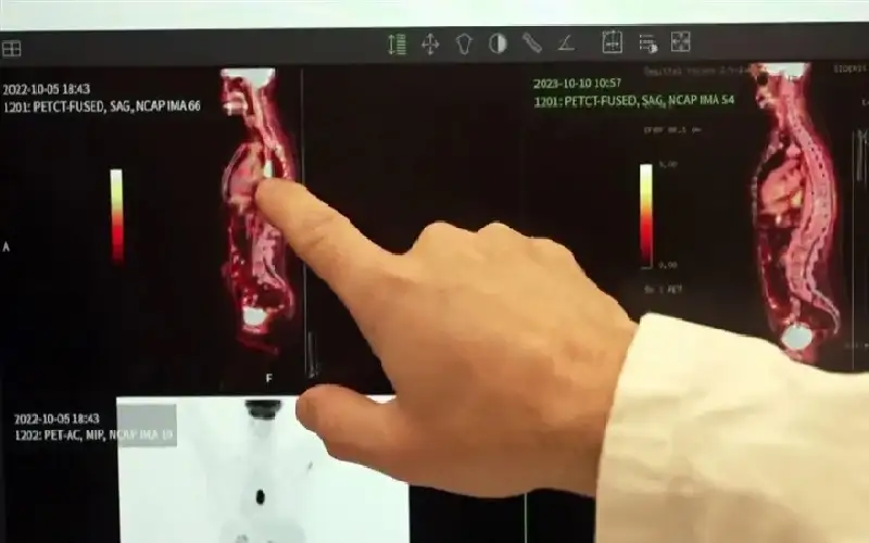 علاج جديد لتفتيت الخلايا السرطانية بالأشعة