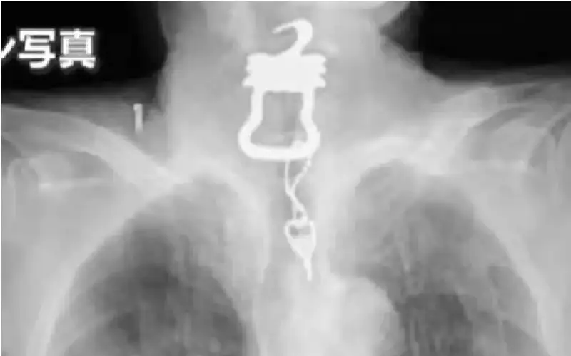 اليابان.. تحقيقات في وفاة مريض ابتلع