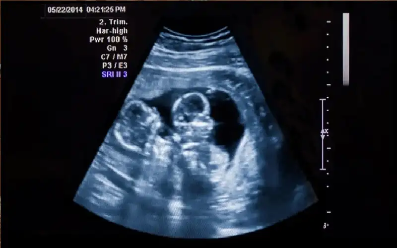 توتر الحامل يؤثر على نمو قلب