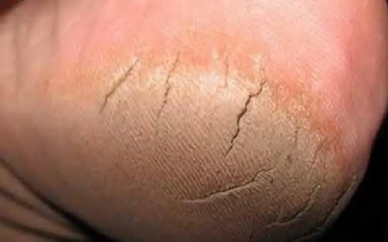 أسباب تشقق القدمين وطرق العلاج