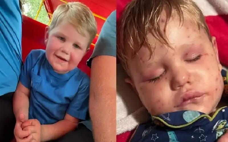 طفل يصطدم بـعش دبابير ويلدغ 150