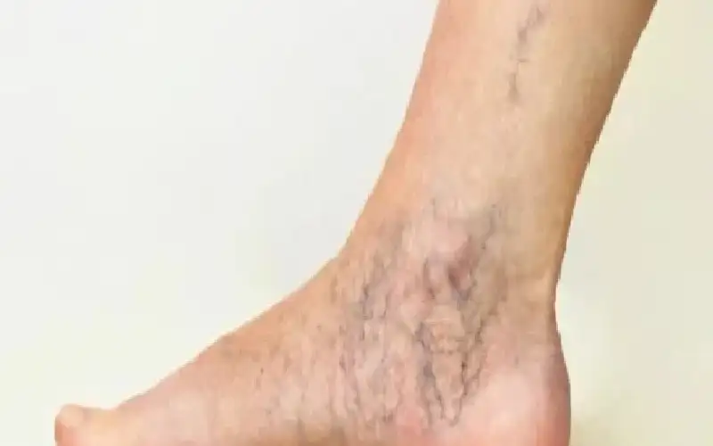 برودة الأطراف مؤشر مبكر يسبق دوالي