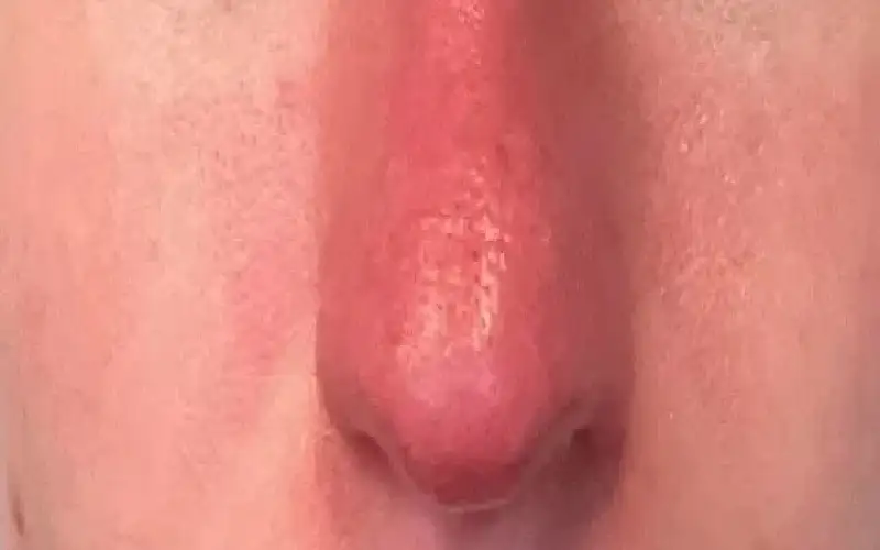 الوردية.. حالة جلدية تسببها حروق الشمس