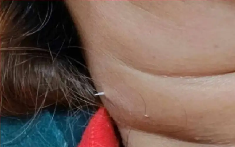 حادثة أذهلت الأطباء.. عظمة سمكة عالقة