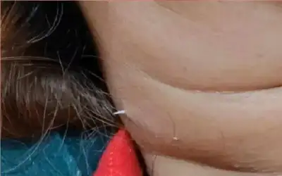 حادثة أذهلت الأطباء.. عظمة سمكة عالقة