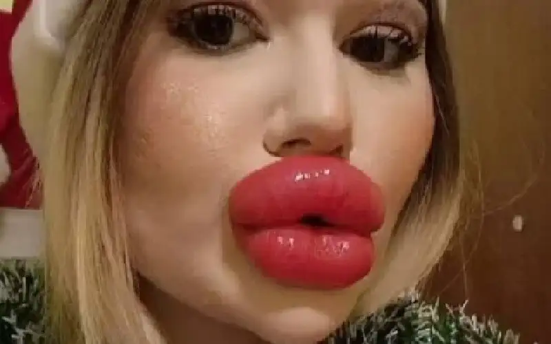 بسبب مظهرها.. صاحبة أكبر شفاه في