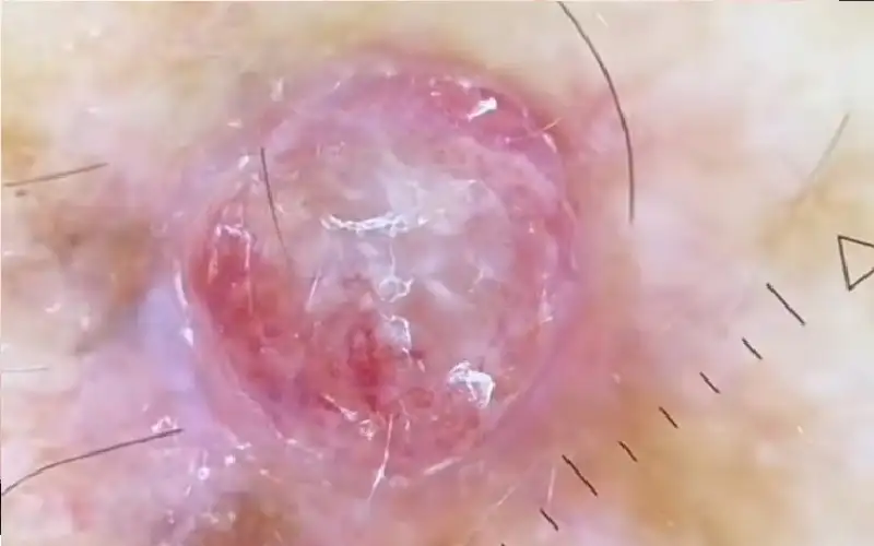 تحذير خطير.. سرطان الميلانوما قد يخفي