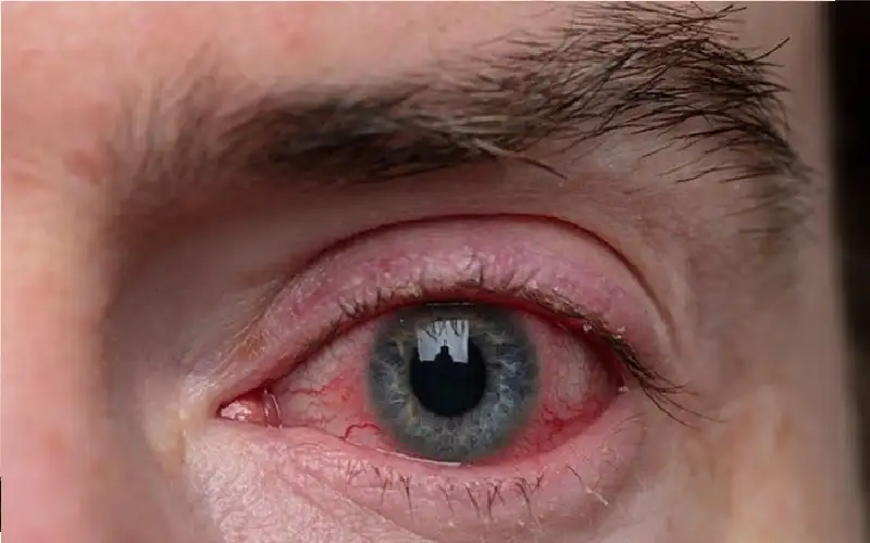 الدواء الذي قد يطفئ البصر.. تحذير