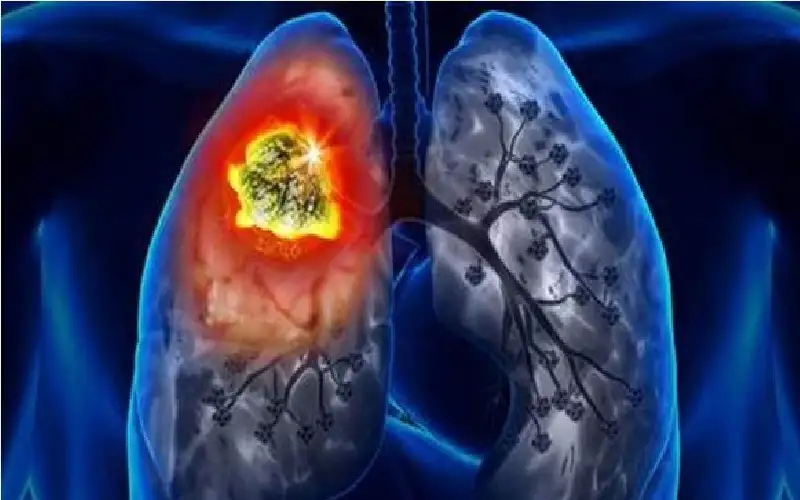 دخنت سيجارة فأصيبت بفطر قاتل في