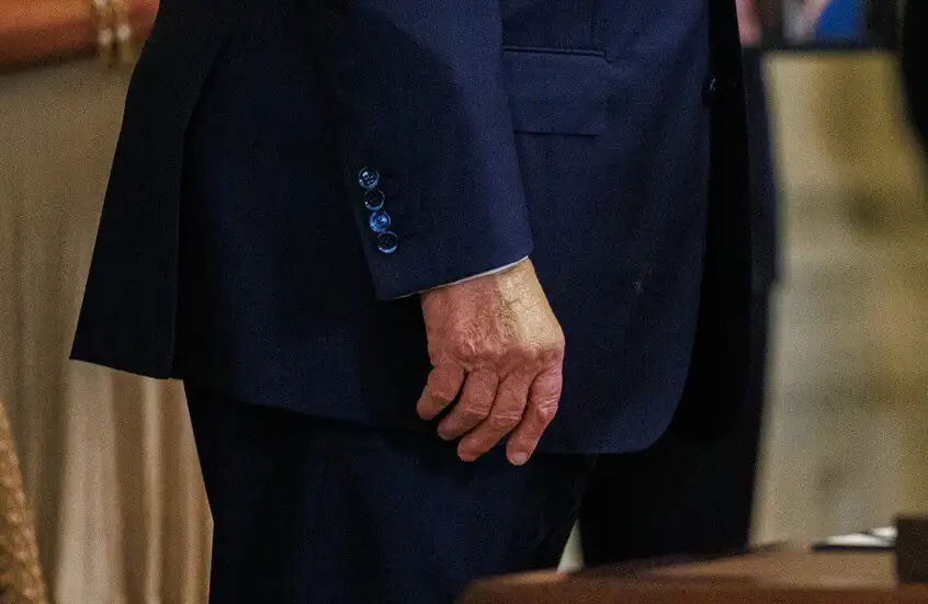 خبراء يكشفون الحقيقة وراء الكدمات المتكررة