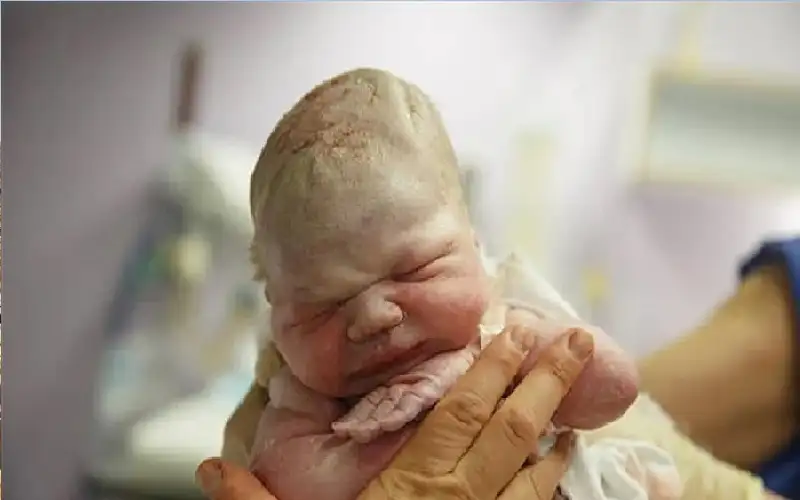 ولادة نادرة بمتلازمة الطفل الشمعي
