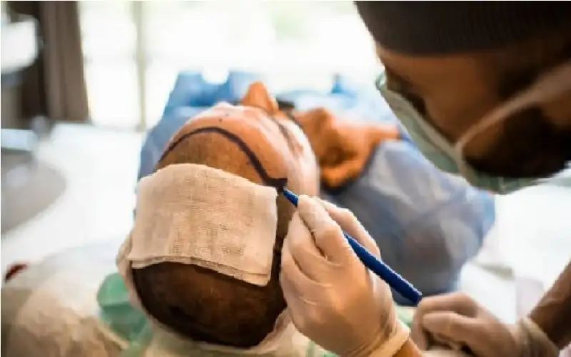 قبل عملية زراعة الشعر.. وفاة غامضة